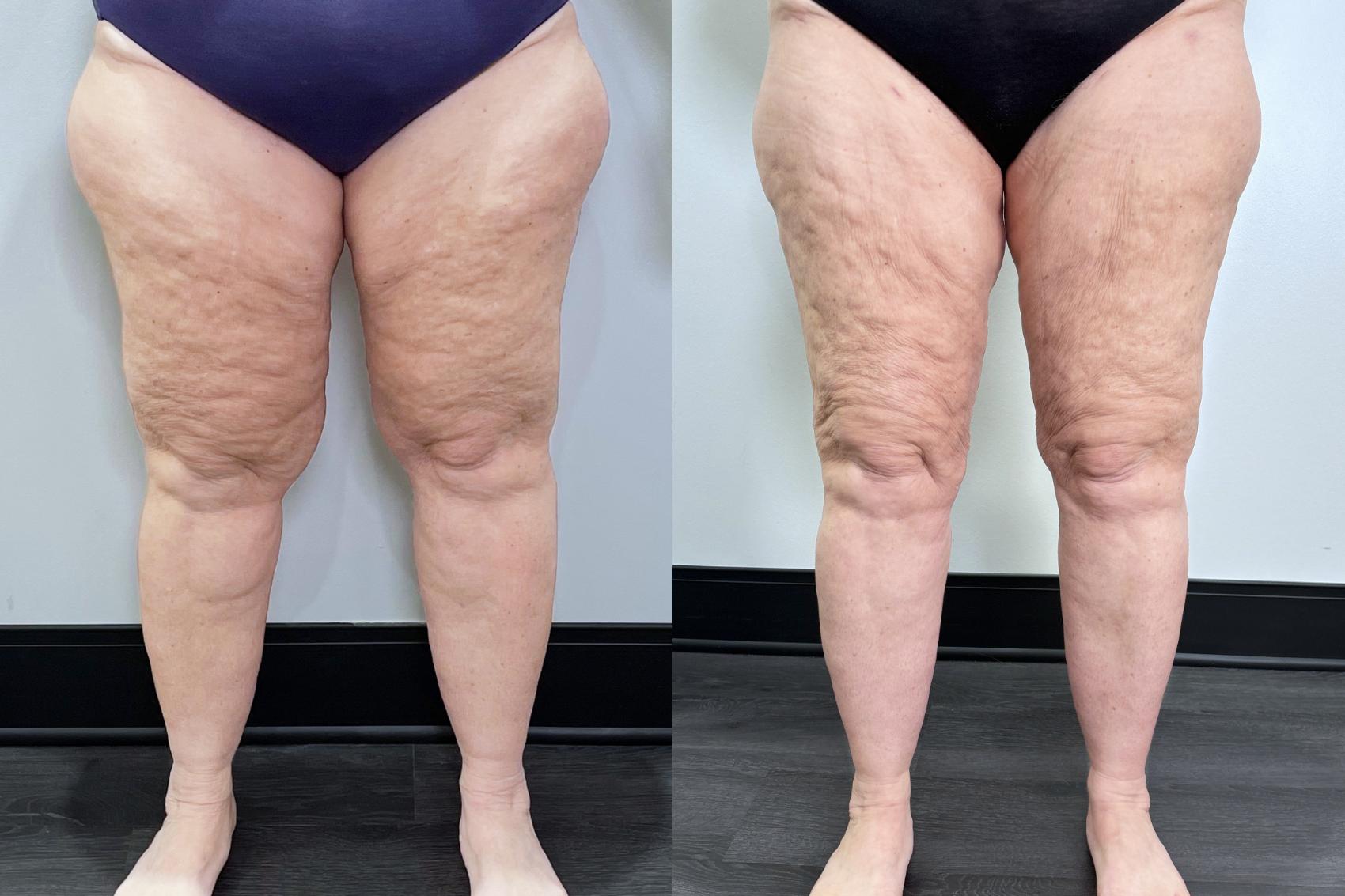 Before & After Lipedema Surgery Case 134 Front View in Atlanta, GA