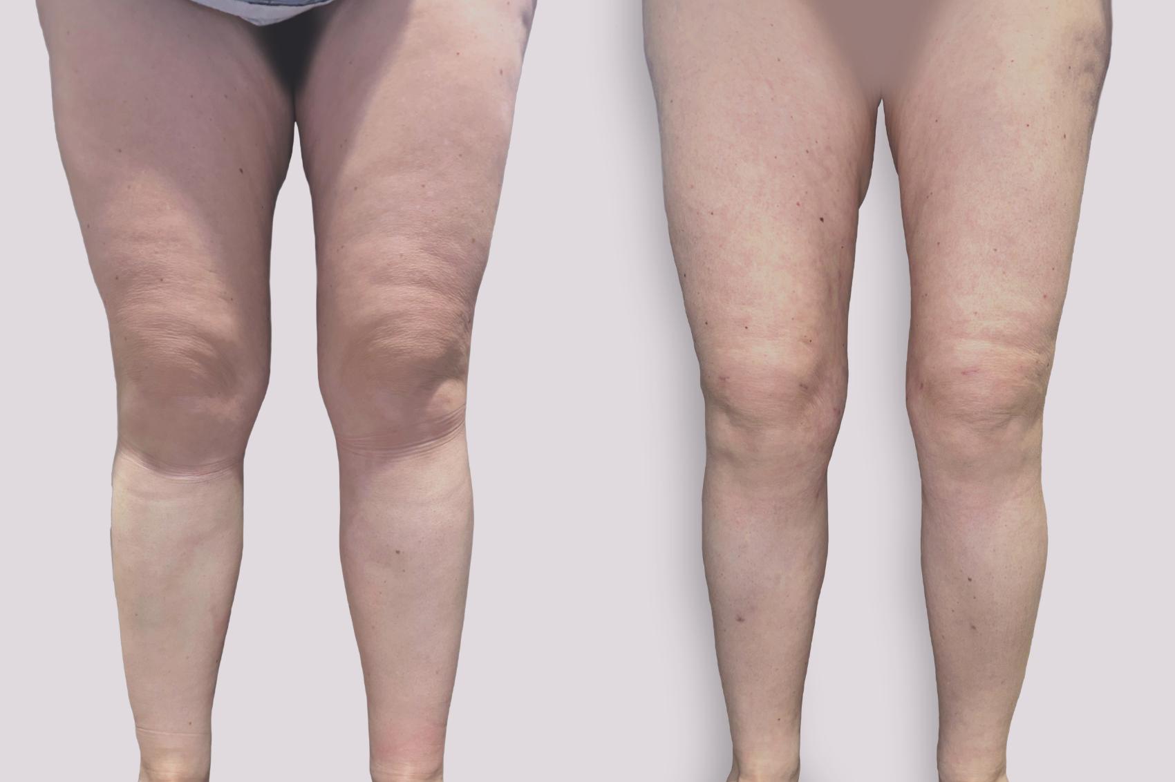 Before & After Lipedema Surgery Case 138 Front View in Atlanta, GA