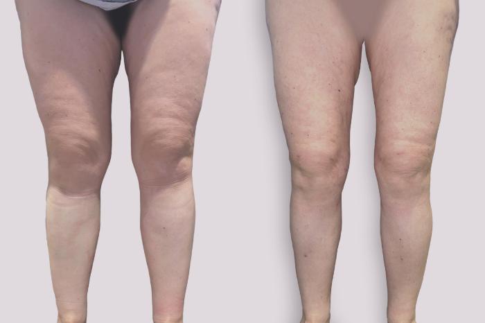 Before & After Lipedema Surgery Case 138 Front View in Atlanta, GA