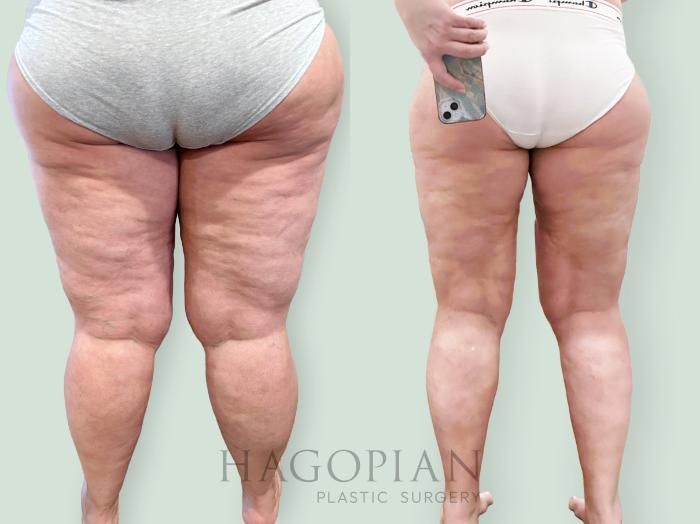 Before & After Lipedema Surgery Case 139 Back View in Atlanta, GA