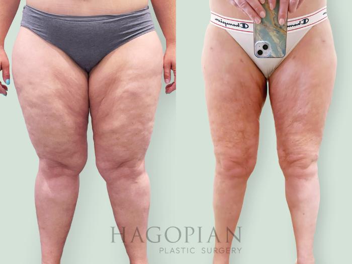 Before & After Lipedema Surgery Case 139 Front View in Atlanta, GA