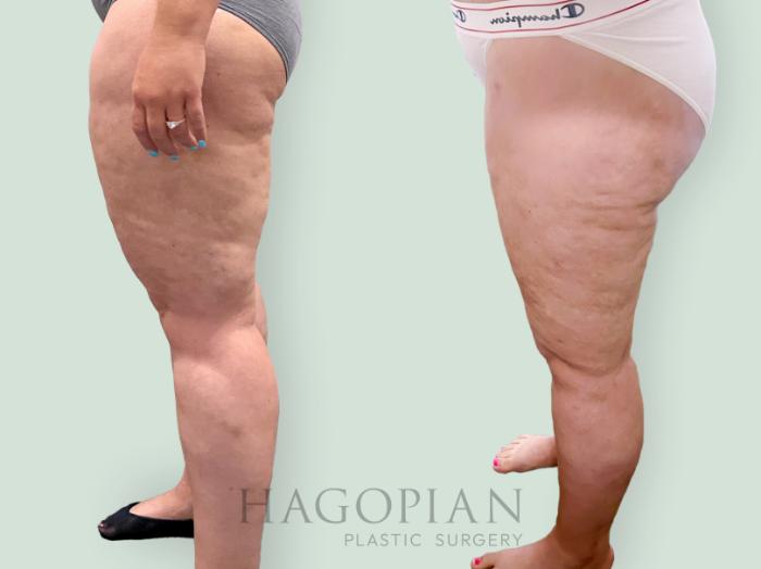 Before & After Lipedema Surgery Case 139 Left Side View in Atlanta, GA