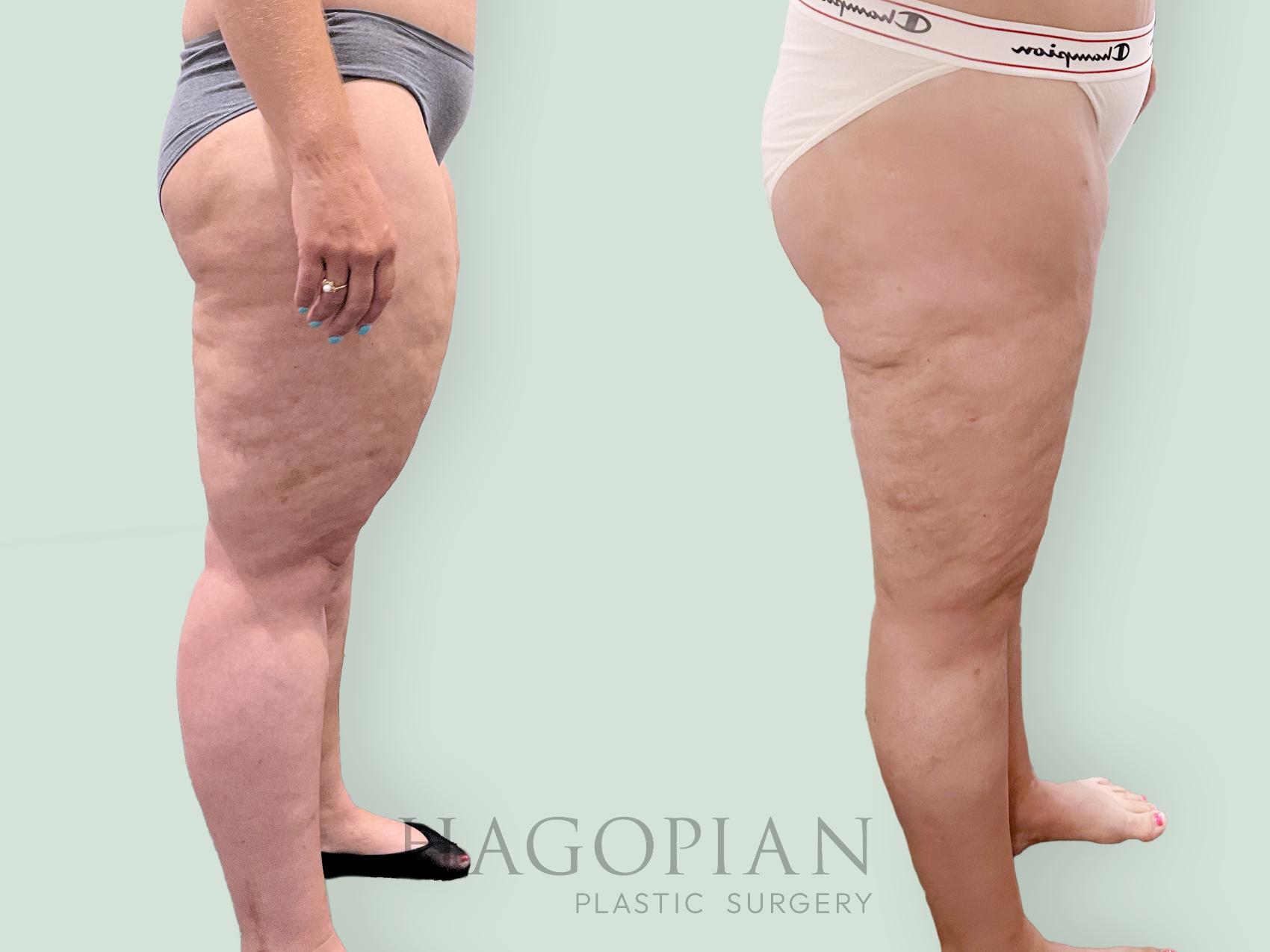 Before & After Lipedema Surgery Case 139 Right Side View in Atlanta, GA