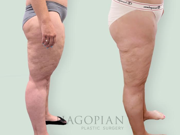 Before & After Lipedema Surgery Case 139 Right Side View in Atlanta, GA