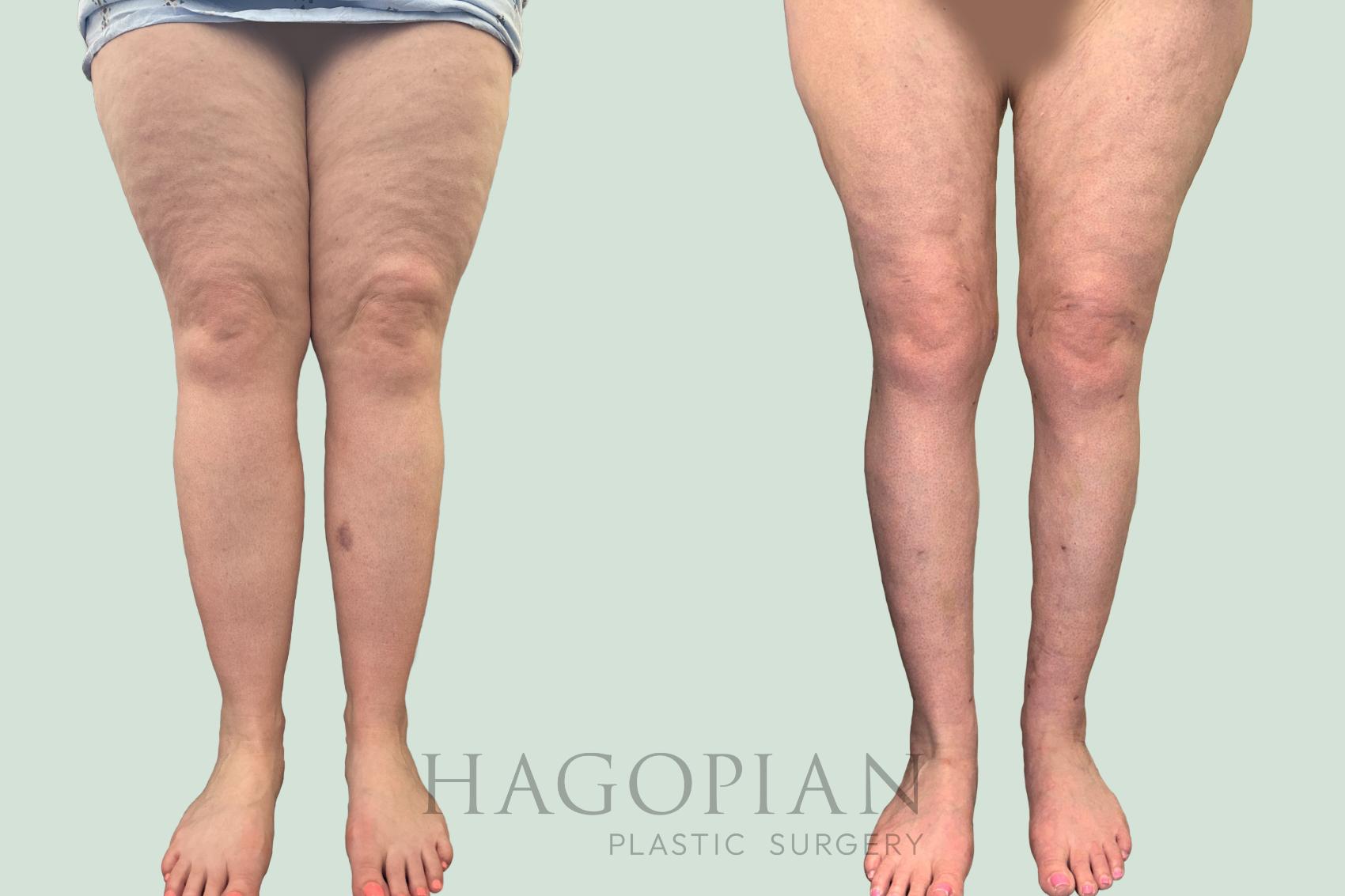 Before & After Lipedema Surgery Case 140 Front View in Atlanta, GA