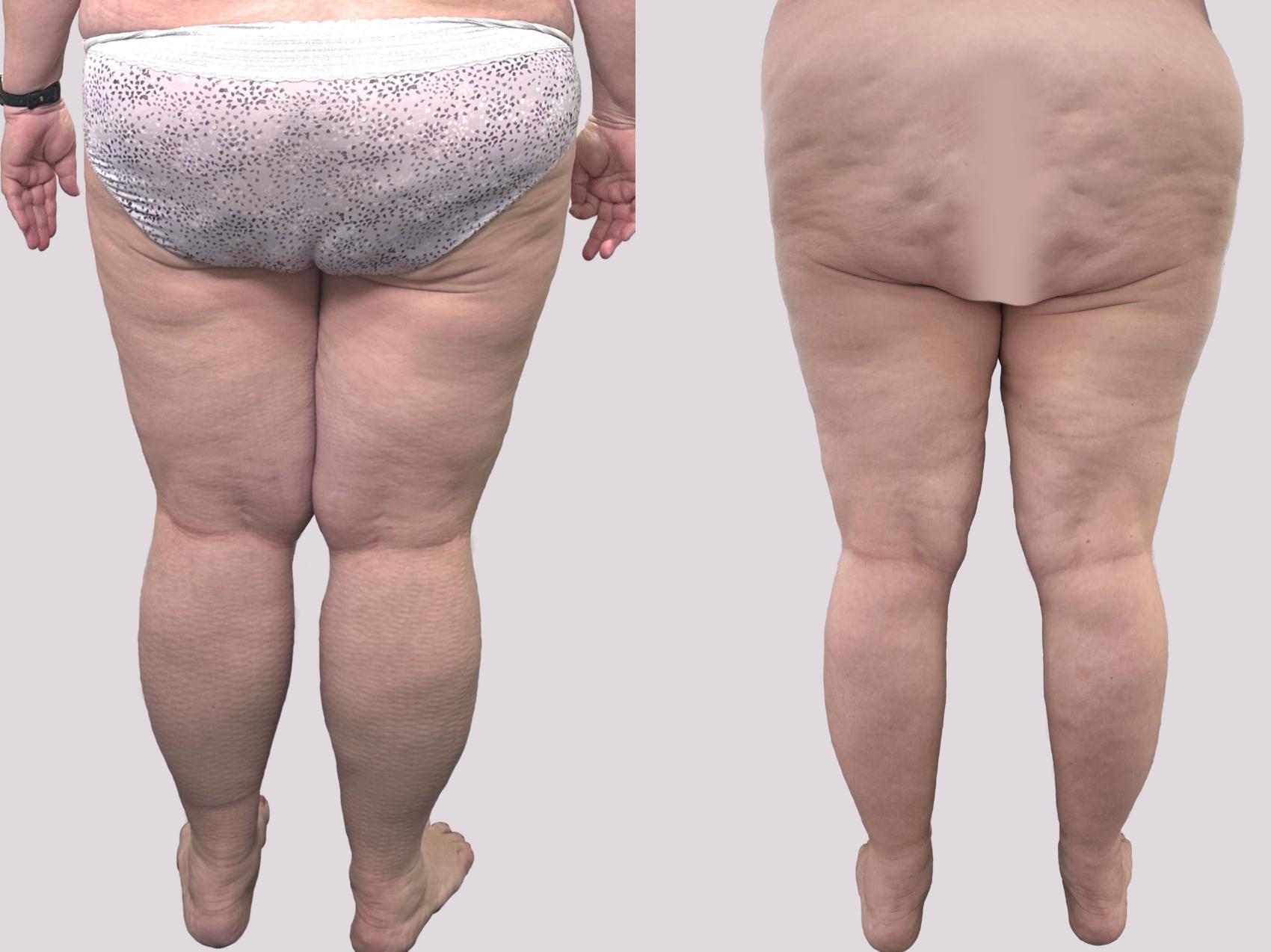 Before & After Lipedema Surgery Case 145 Back View in Atlanta, GA