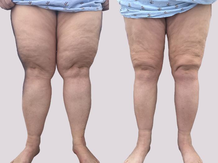 Before & After Lipedema Surgery Case 145 Front View in Atlanta, GA