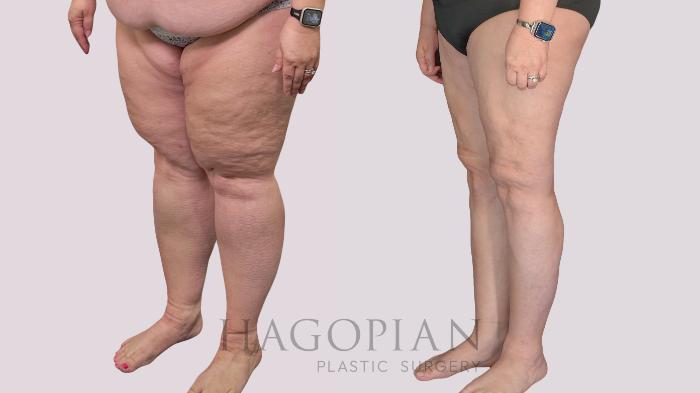 Before & After Thigh Lift Case 145 Left Oblique View in Atlanta, GA