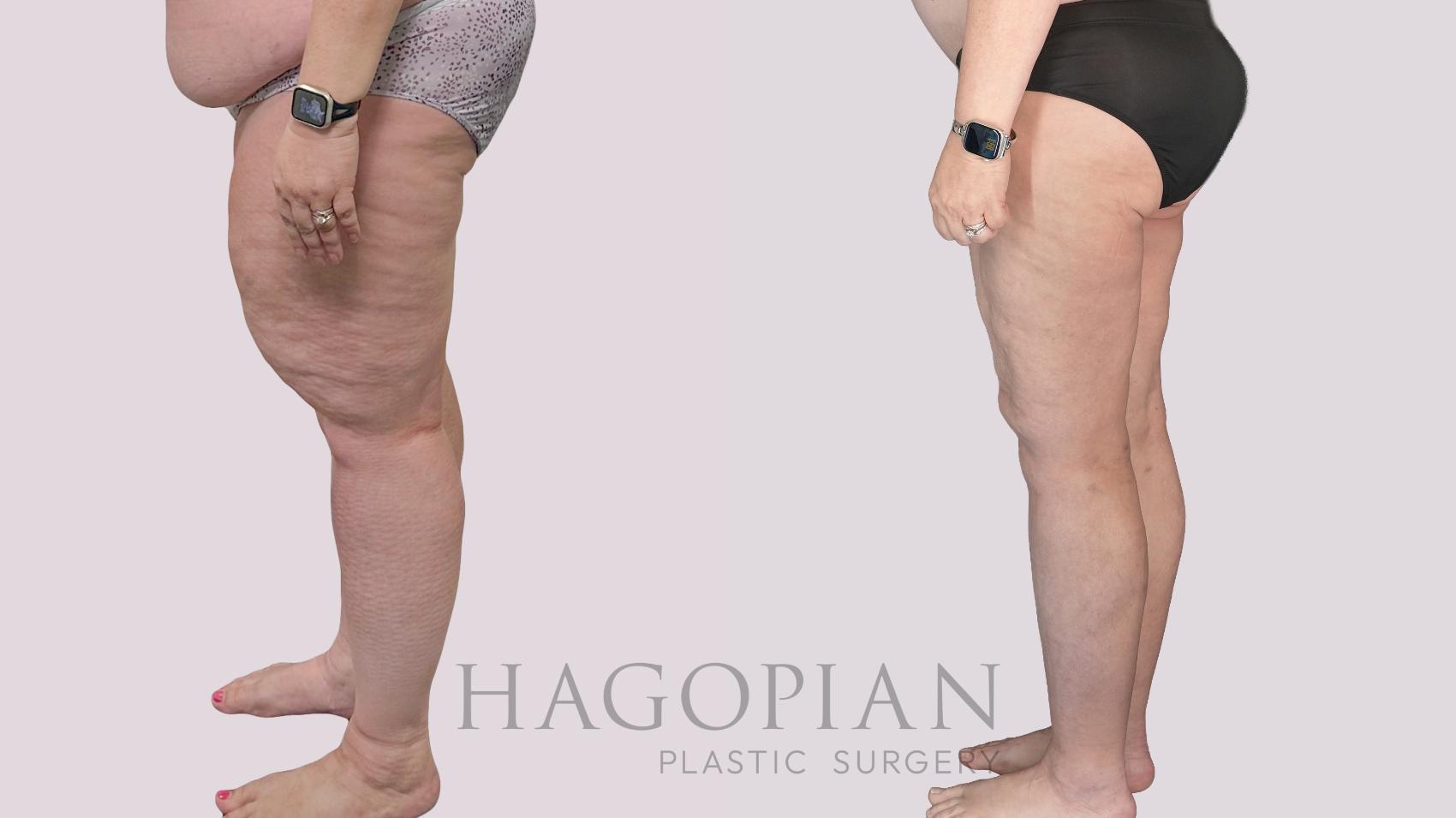 Before & After Thigh Lift Case 145 Left Side View in Atlanta, GA