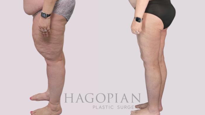 Before & After Thigh Lift Case 145 Left Side View in Atlanta, GA
