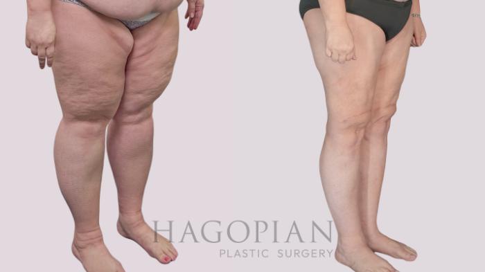 Before & After Thigh Lift Case 145 Right Oblique View in Atlanta, GA