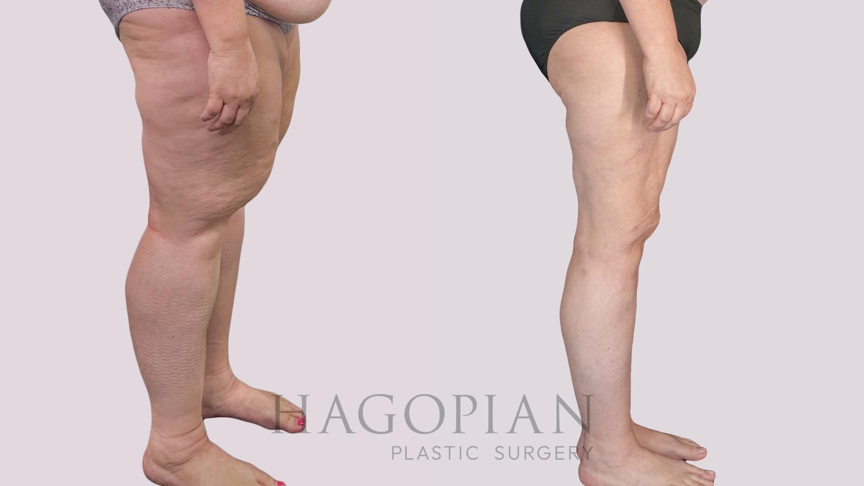 Before & After Thigh Lift Case 145 Right Side View in Atlanta, GA