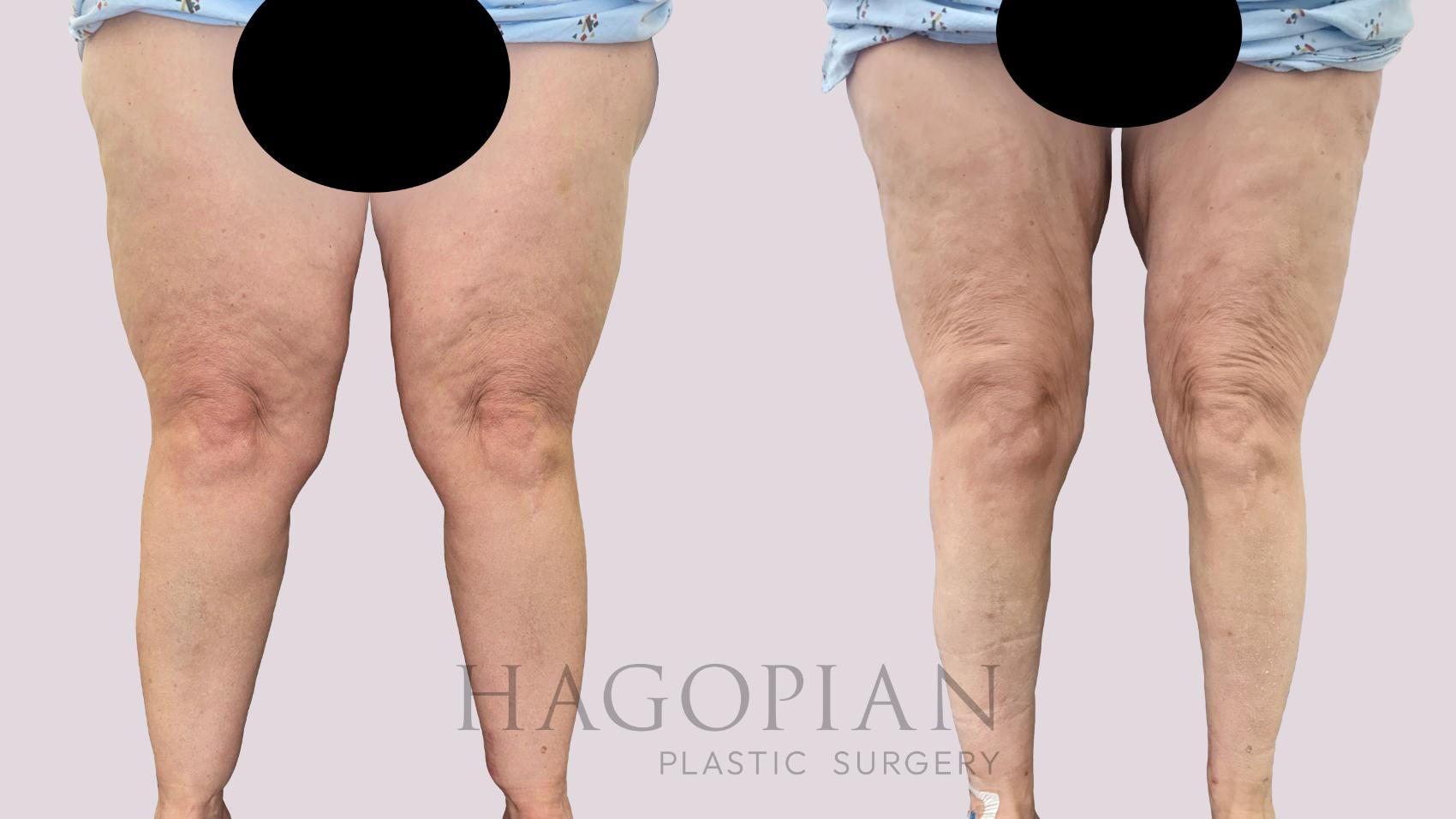 Before & After Lipedema Surgery Case 150 Front View in Atlanta, GA