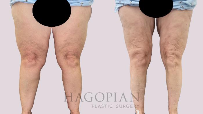 Before & After Lipedema Surgery Case 150 Front View in Atlanta, GA