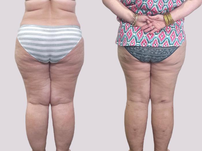 Before & After Lipedema Surgery Case 155 Back View in Atlanta, GA