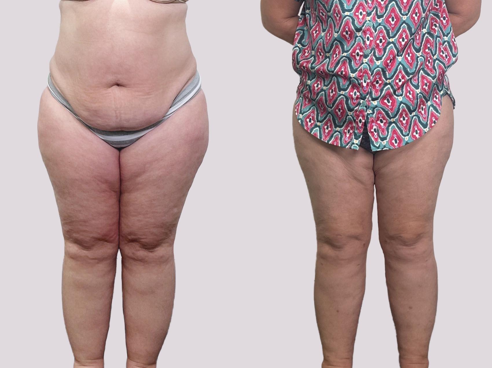 Before & After Lipedema Surgery Case 155 Front View in Atlanta, GA