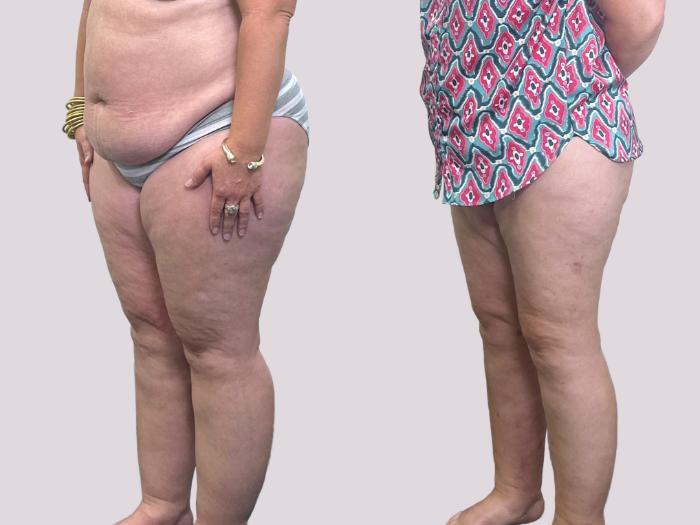 Before & After Lipedema Surgery Case 155 Left Oblique View in Atlanta, GA