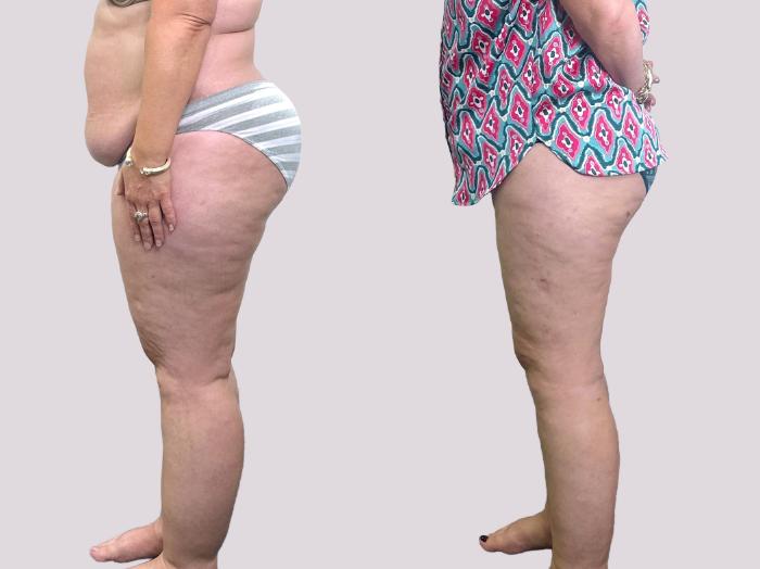 Before & After Lipedema Surgery Case 155 Left Side View in Atlanta, GA