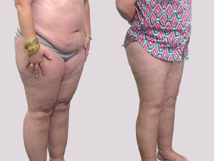 Before & After Lipedema Surgery Case 155 Right Oblique View in Atlanta, GA