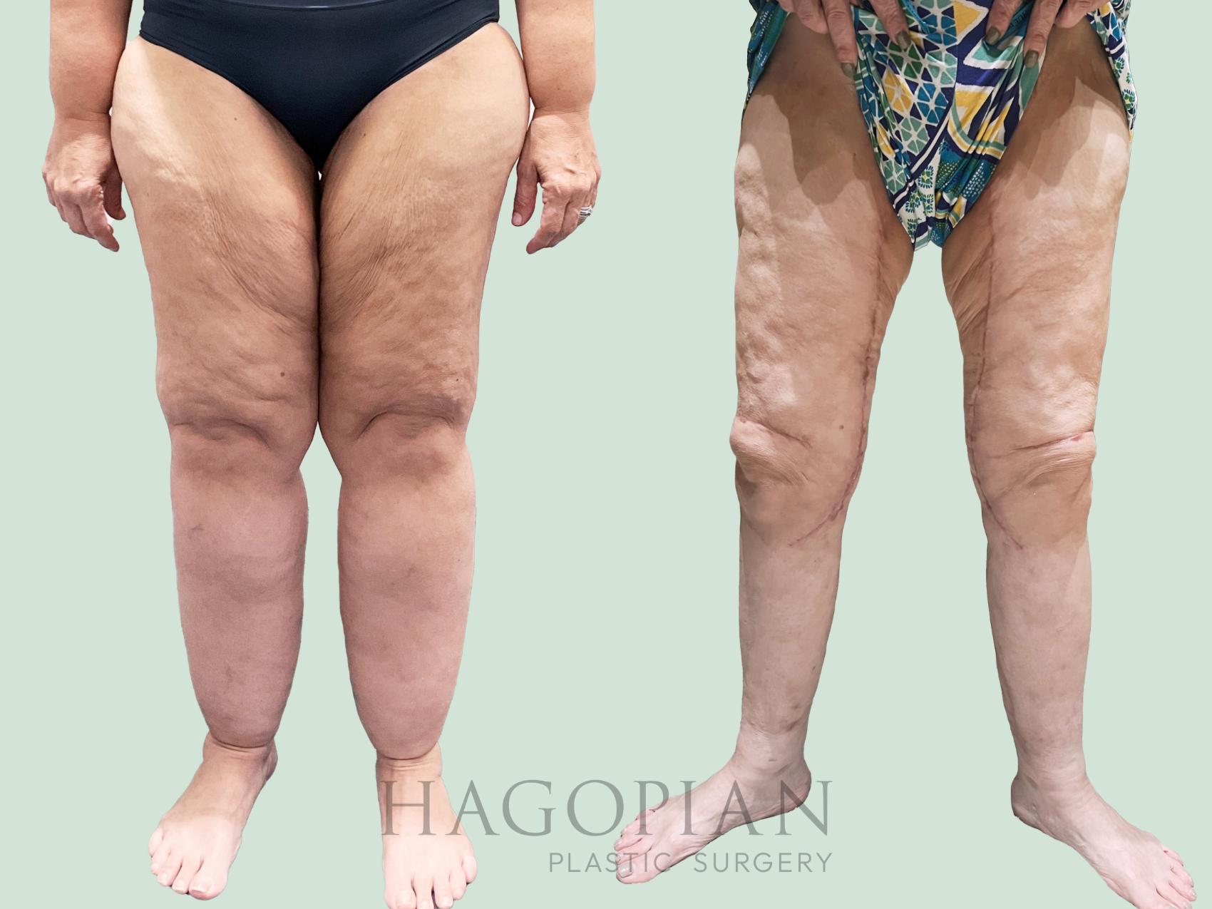 Before & After Lipedema Surgery Case 159 Left Side View in Atlanta, GA