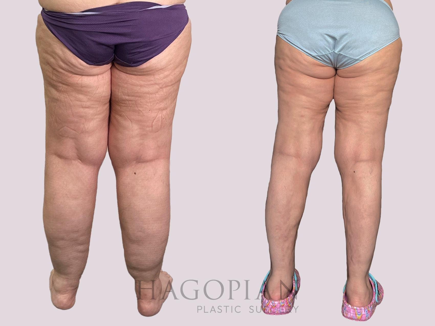 Before & After Lipedema Surgery Case 160 Back View in Atlanta, GA