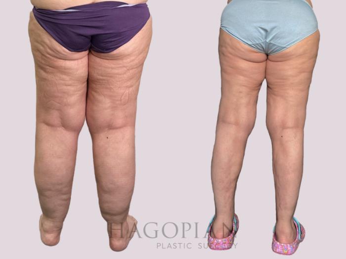 Before & After Lipedema Surgery Case 160 Back View in Atlanta, GA