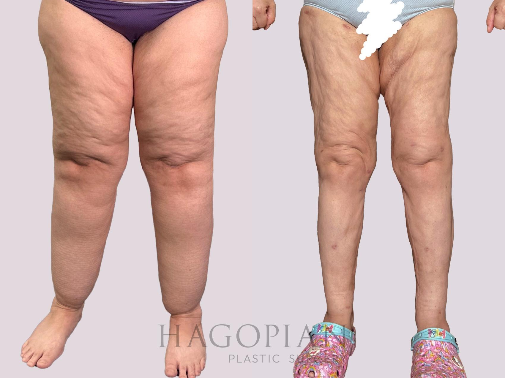 Before & After Lipedema Surgery Case 160 Front View in Atlanta, GA