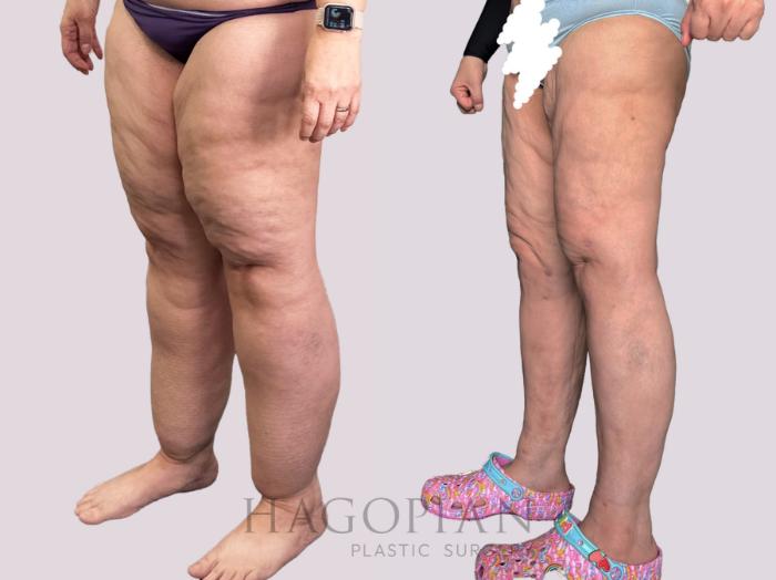 Before & After Lipedema Surgery Case 160 Left Oblique View in Atlanta, GA