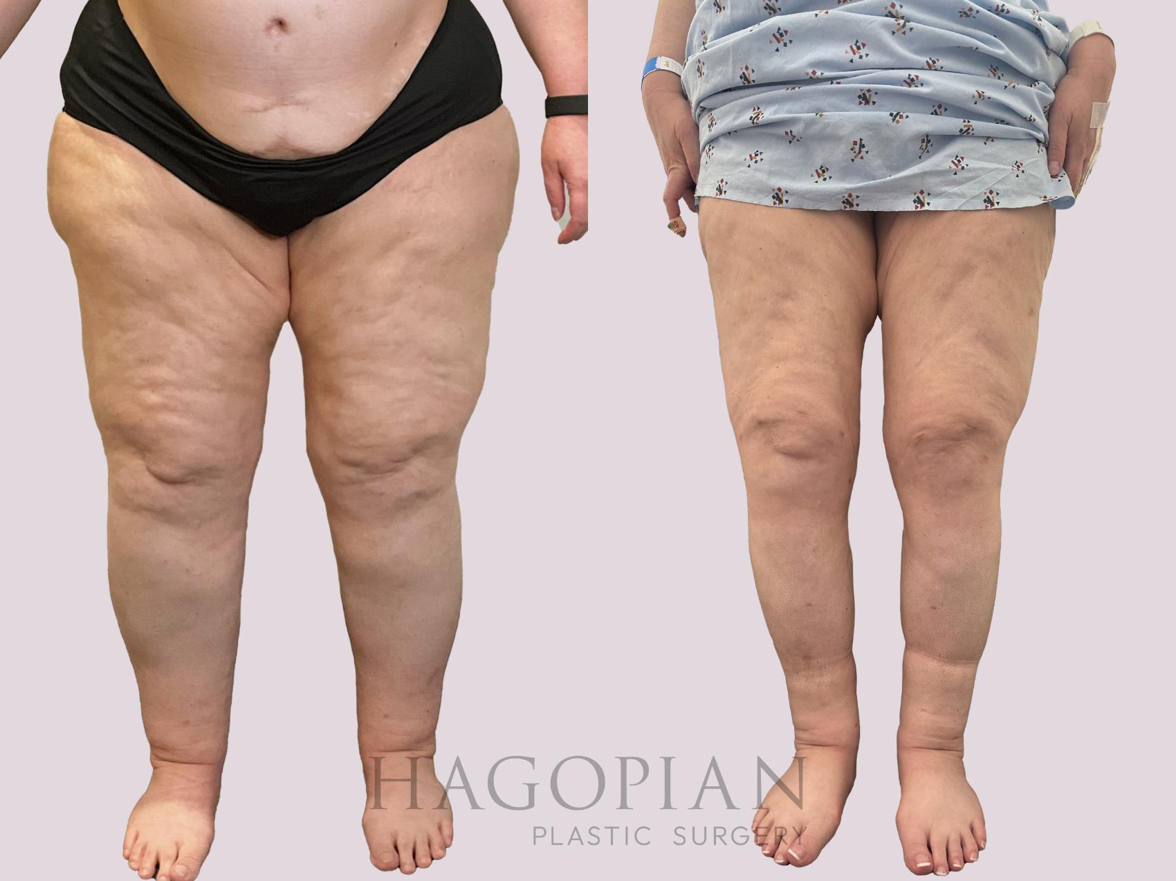 Before & After Lipedema Surgery Case 161 Front View in Atlanta, GA