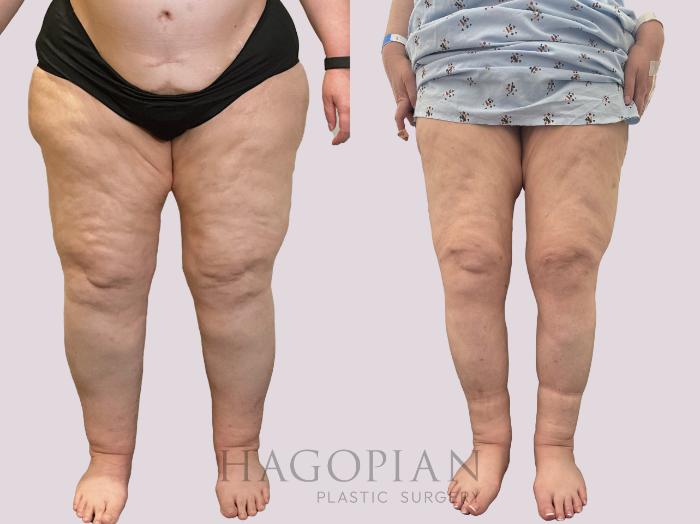 Before & After Lipedema Surgery Case 161 Front View in Atlanta, GA