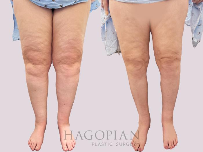 Before & After Lipedema Surgery Case 168 Front View in Atlanta, GA