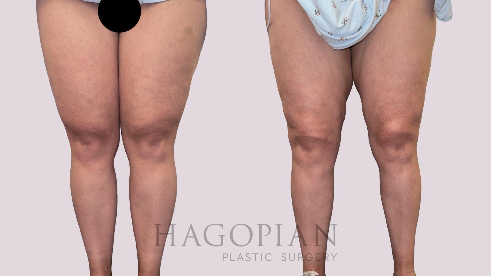 Before & After Lipedema Surgery Case 182 Front View in Atlanta, GA