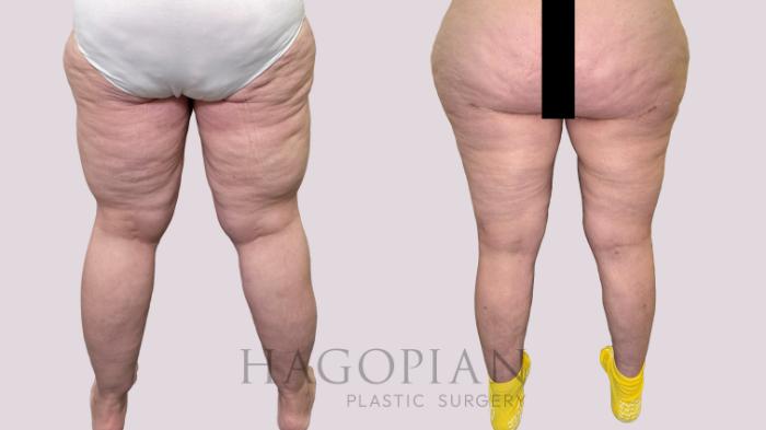 Before & After Lipedema Surgery Case 196 Back View in Atlanta, GA