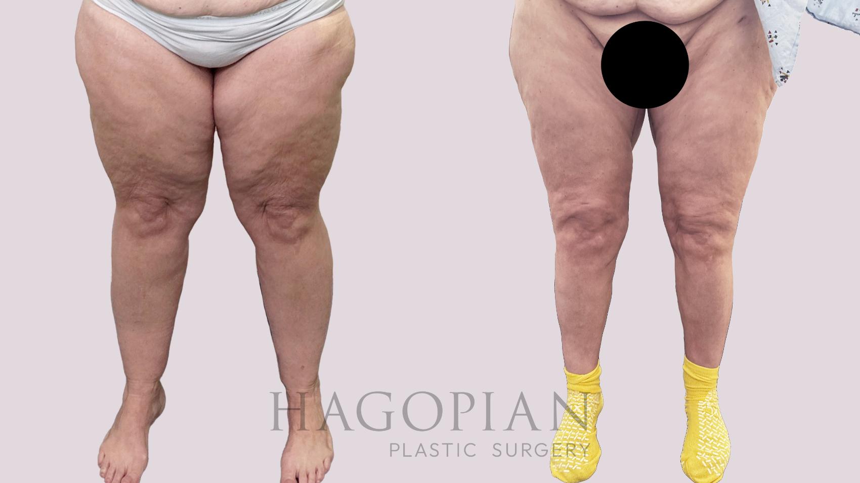 Before & After Lipedema Surgery Case 196 Front View in Atlanta, GA