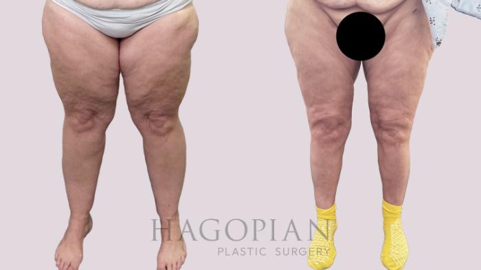 Before & After Lipedema Surgery Case 196 Front View in Atlanta, GA