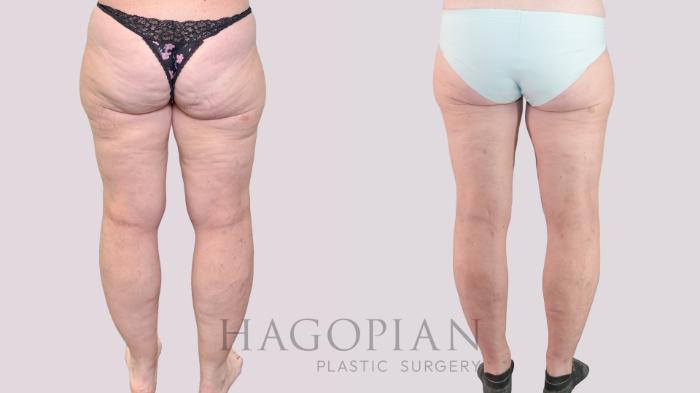 Before & After Lipedema Surgery Case 237 Back View in Atlanta, GA