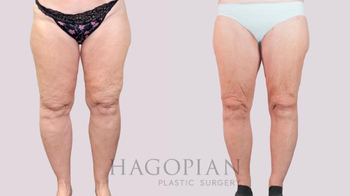 Before & After Lipedema Surgery Case 237 Front View in Atlanta, GA