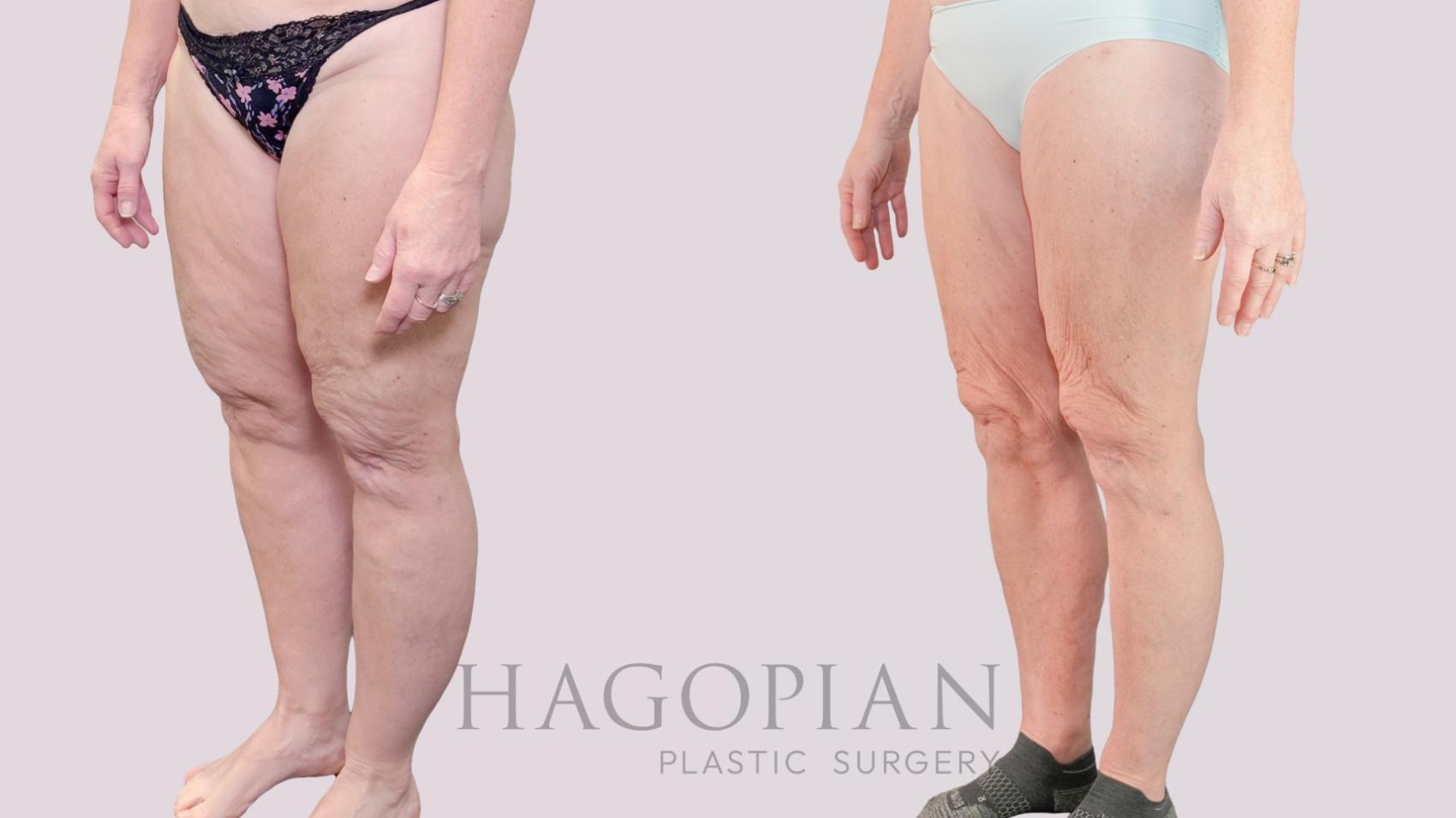Before & After Lipedema Surgery Case 237 Left Oblique View in Atlanta, GA