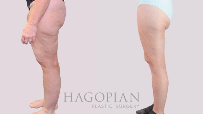 Before & After Lipedema Surgery Case 237 Left Side View in Atlanta, GA