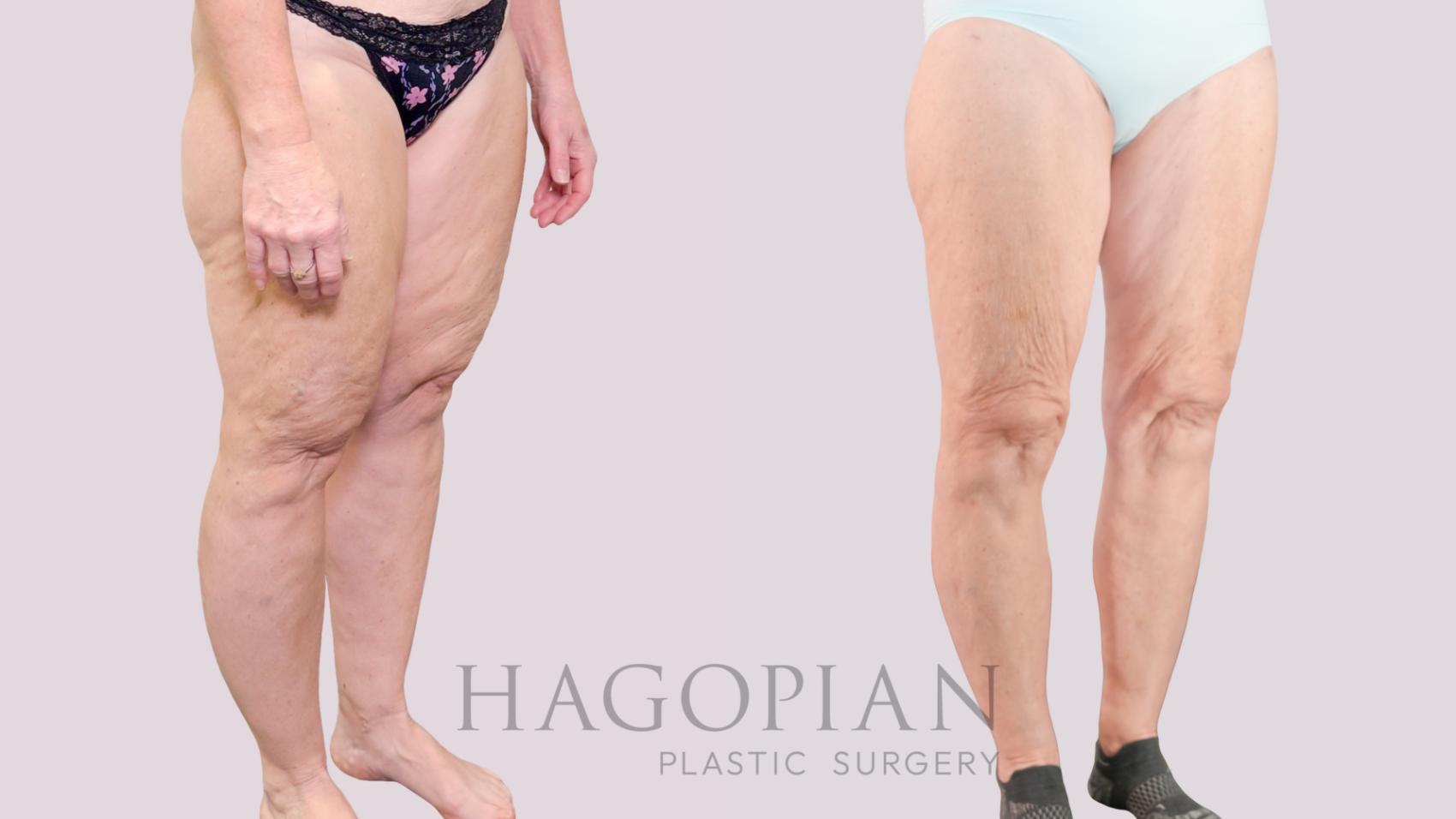 Before & After Lipedema Surgery Case 237 Right Oblique View in Atlanta, GA