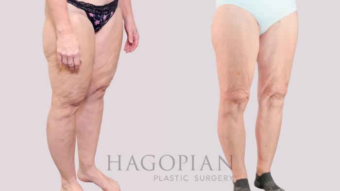 Before & After Lipedema Surgery Case 237 Right Oblique View in Atlanta, GA