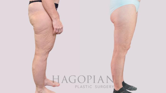 Before & After Lipedema Surgery Case 237 Right Side View in Atlanta, GA