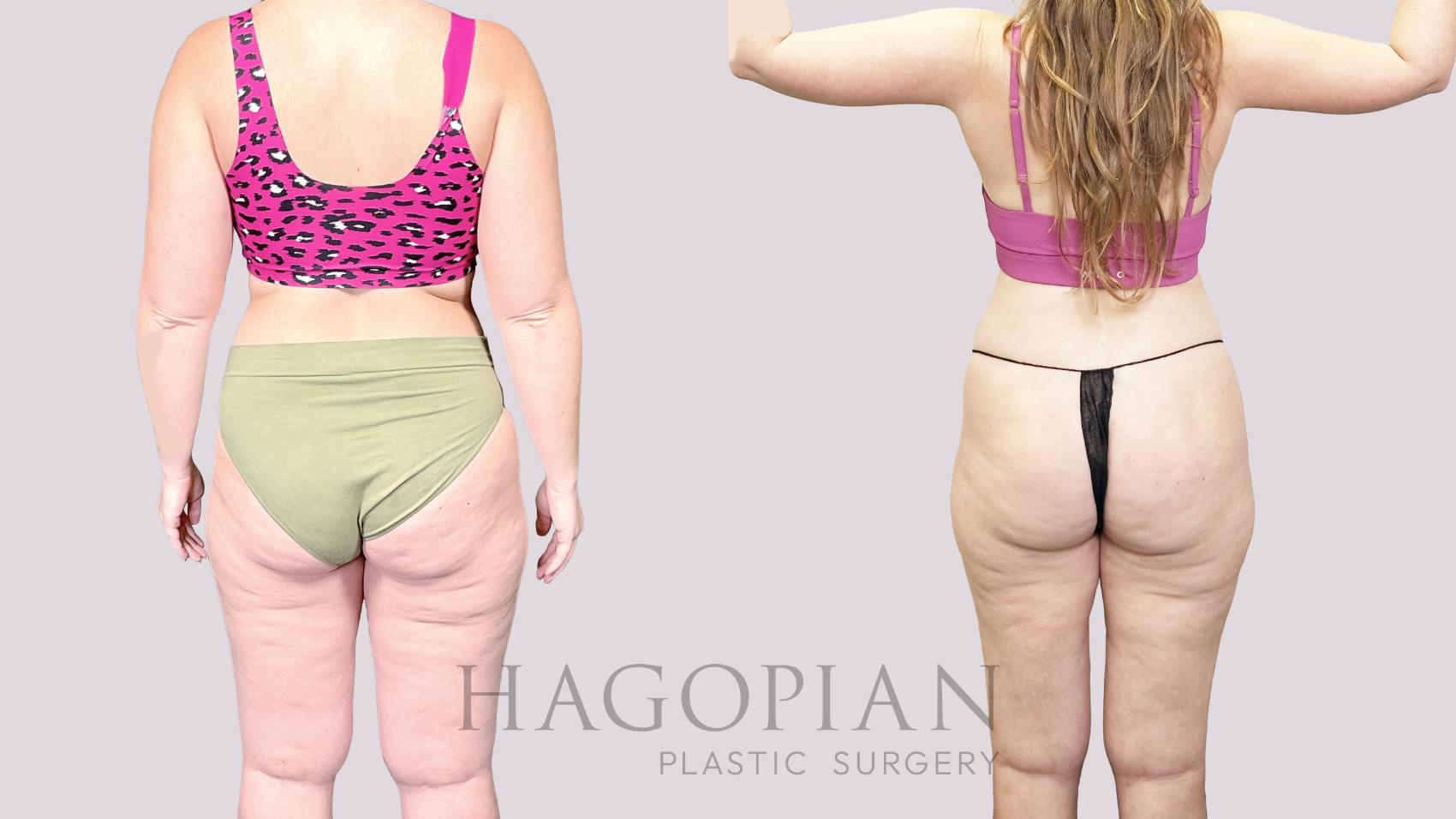 Before & After Lipedema Surgery Case 82 Back View in Atlanta, GA