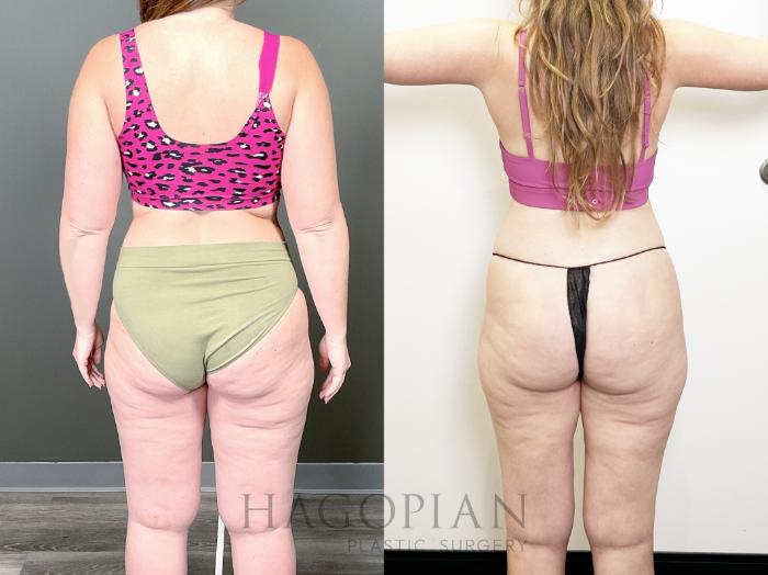 Before & After Lipedema Surgery Case 82 Back View in Atlanta, GA