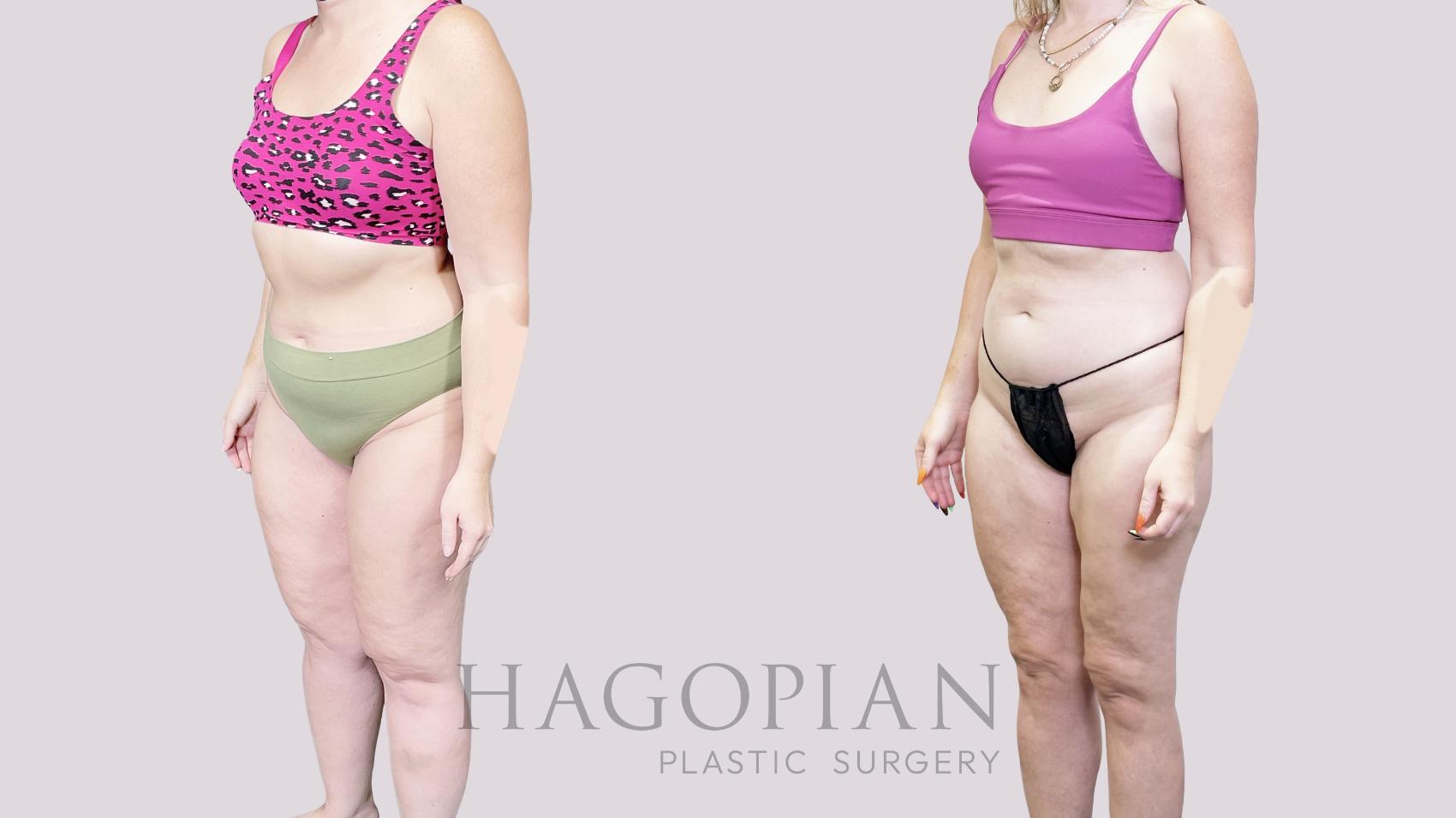 Before & After Lipedema Surgery Case 82 Left Oblique View in Atlanta, GA