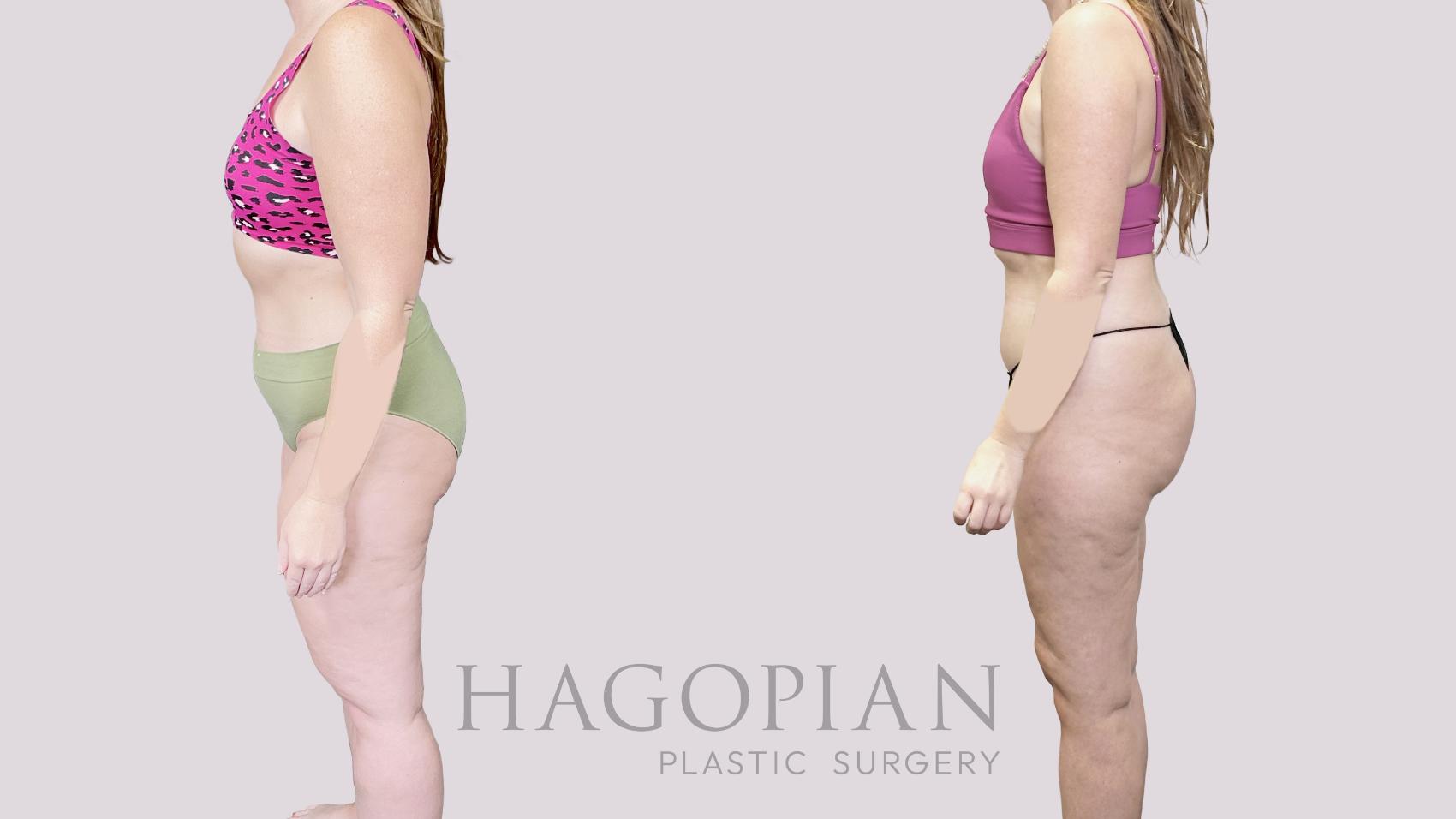 Before & After Lipedema Surgery Case 82 Left Side View in Atlanta, GA