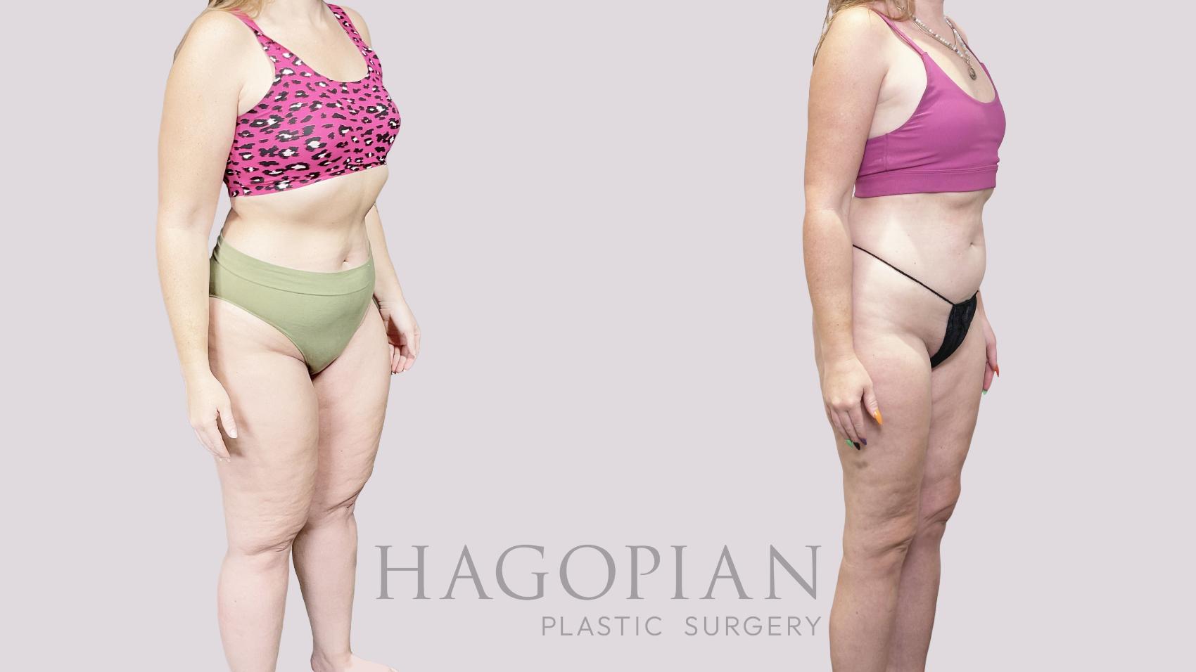 Before & After Lipedema Surgery Case 82 Right Oblique View in Atlanta, GA