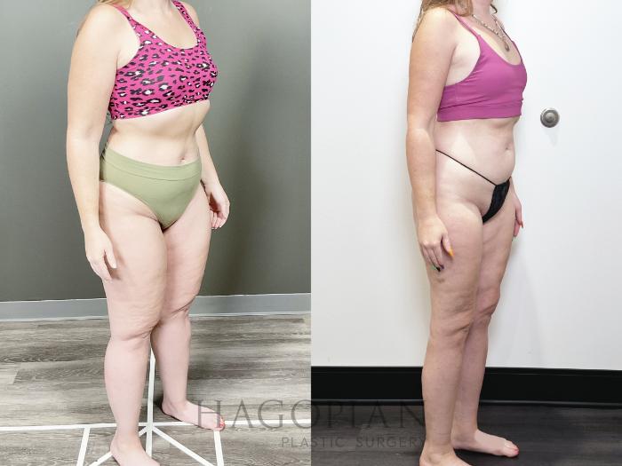 Before & After Lipedema Surgery Case 82 Right Oblique View in Atlanta, GA
