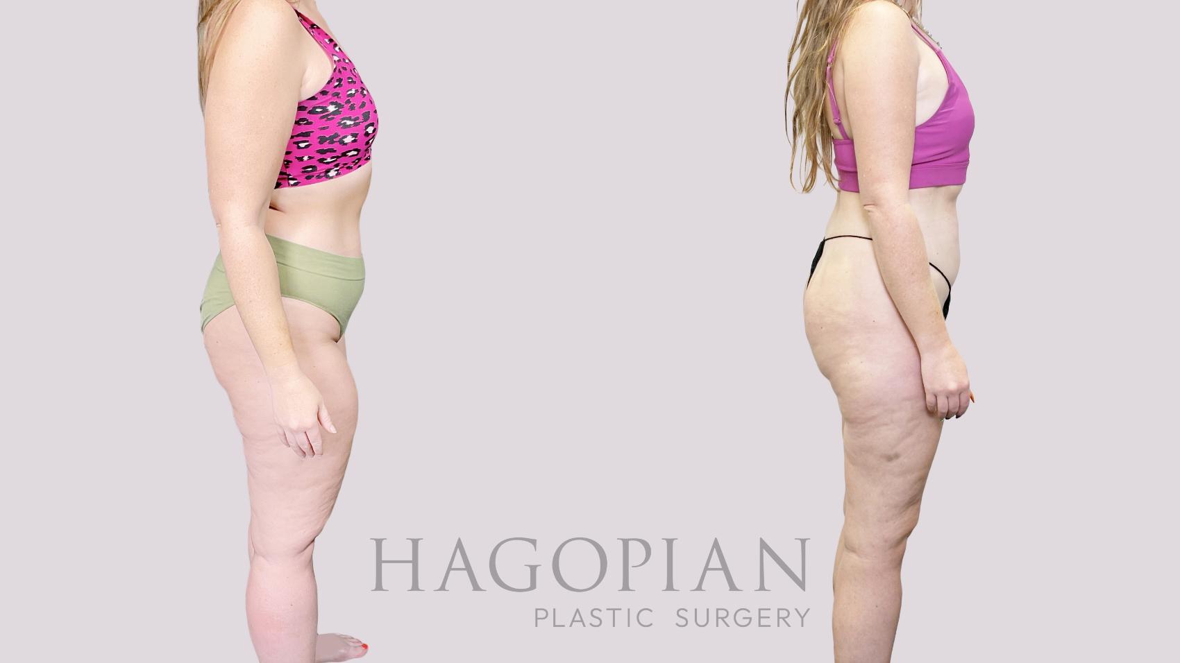 Before & After Lipedema Surgery Case 82 Right Side View in Atlanta, GA