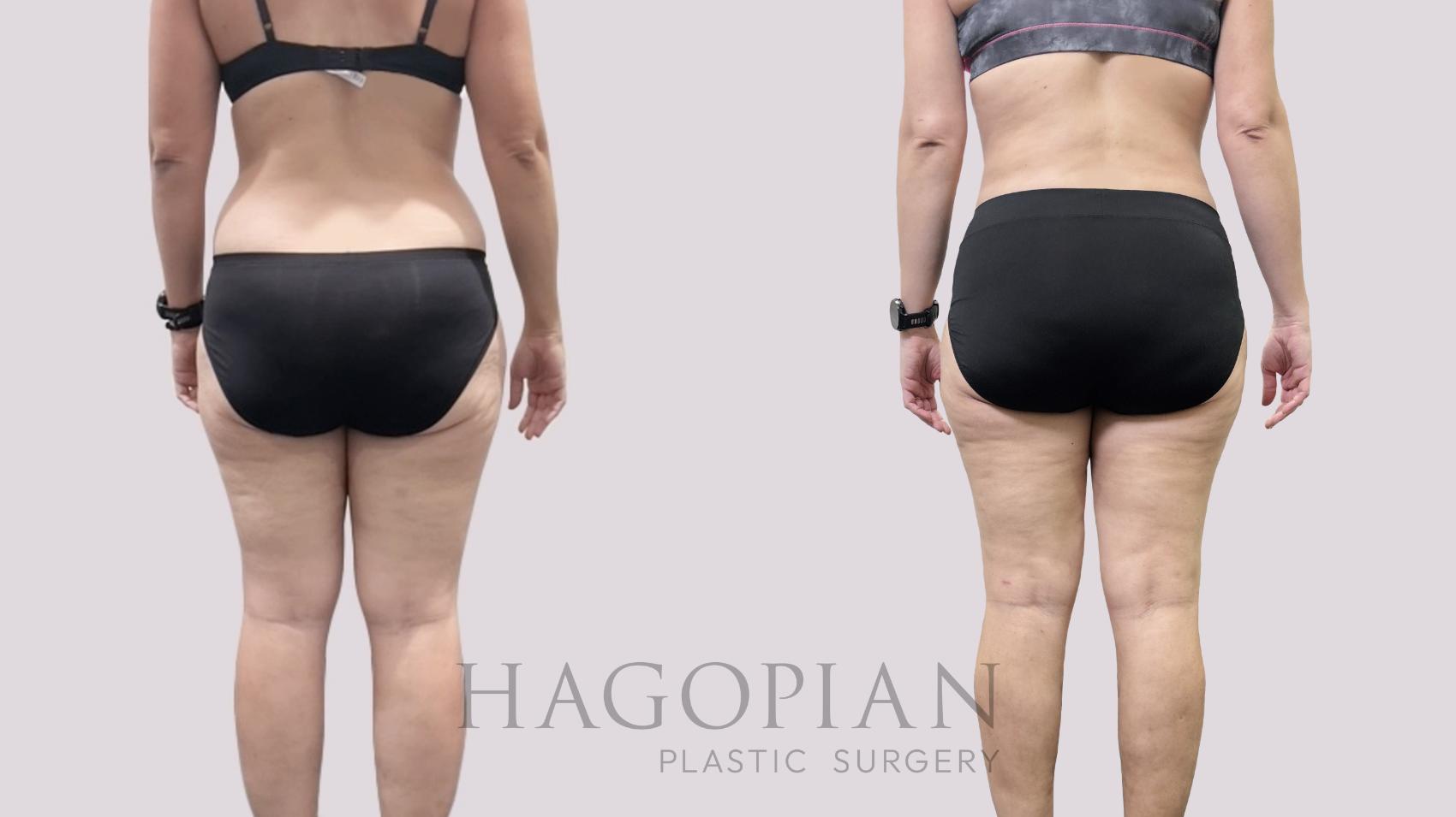 Before & After Liposuction Case 113 Back View in Atlanta, GA